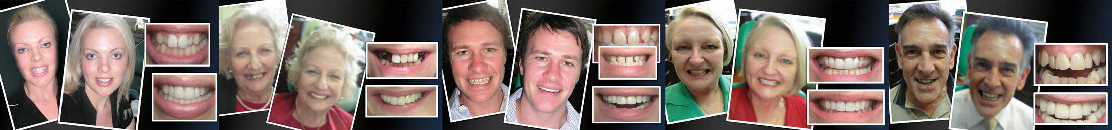 best-Cosmetic-Dentist-in-Melbourne-Before-and-After